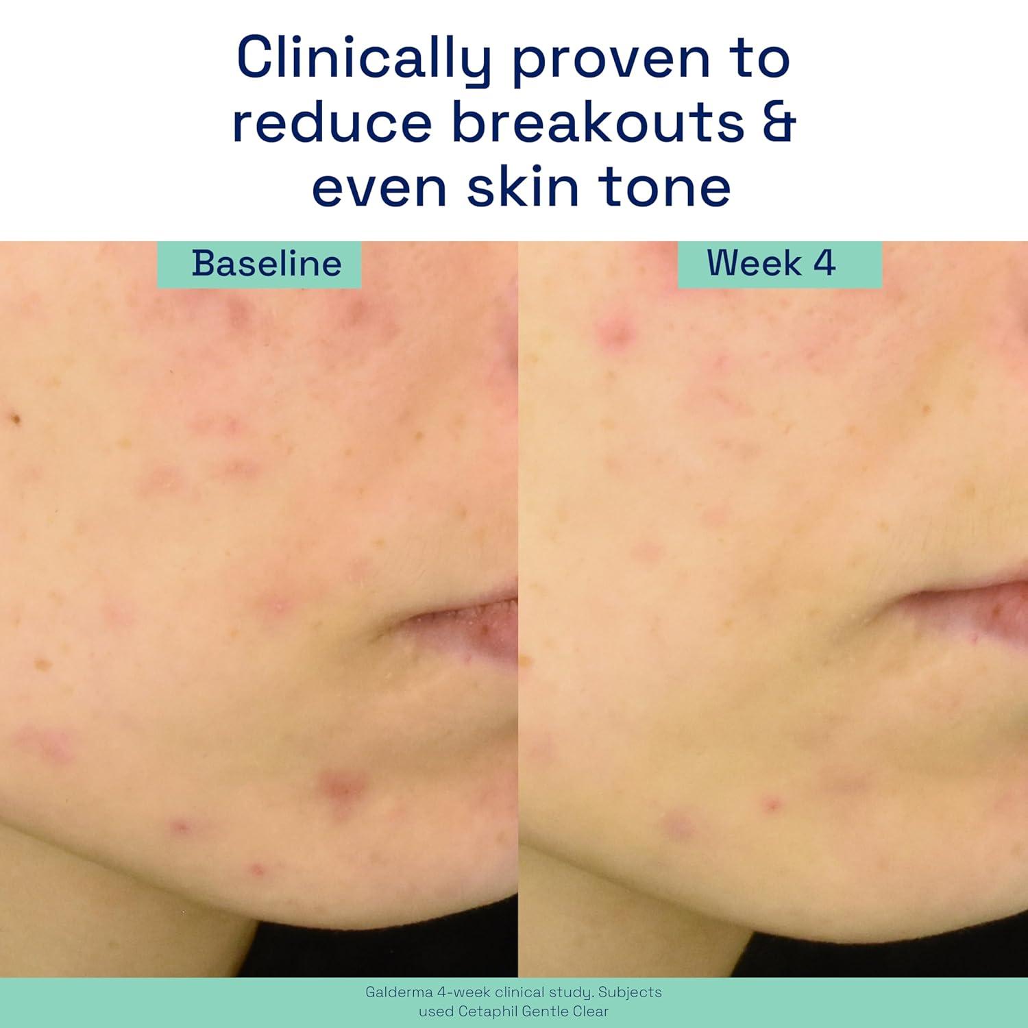 Cetaphil Gentle Clear Complexion-Clearing BPO Acne Cleanser with 2.6% Benzoyl Peroxide, Creamy and Soothing for Sensitive Skin, Suitable for All Skin Types, 4.2oz(Serum)