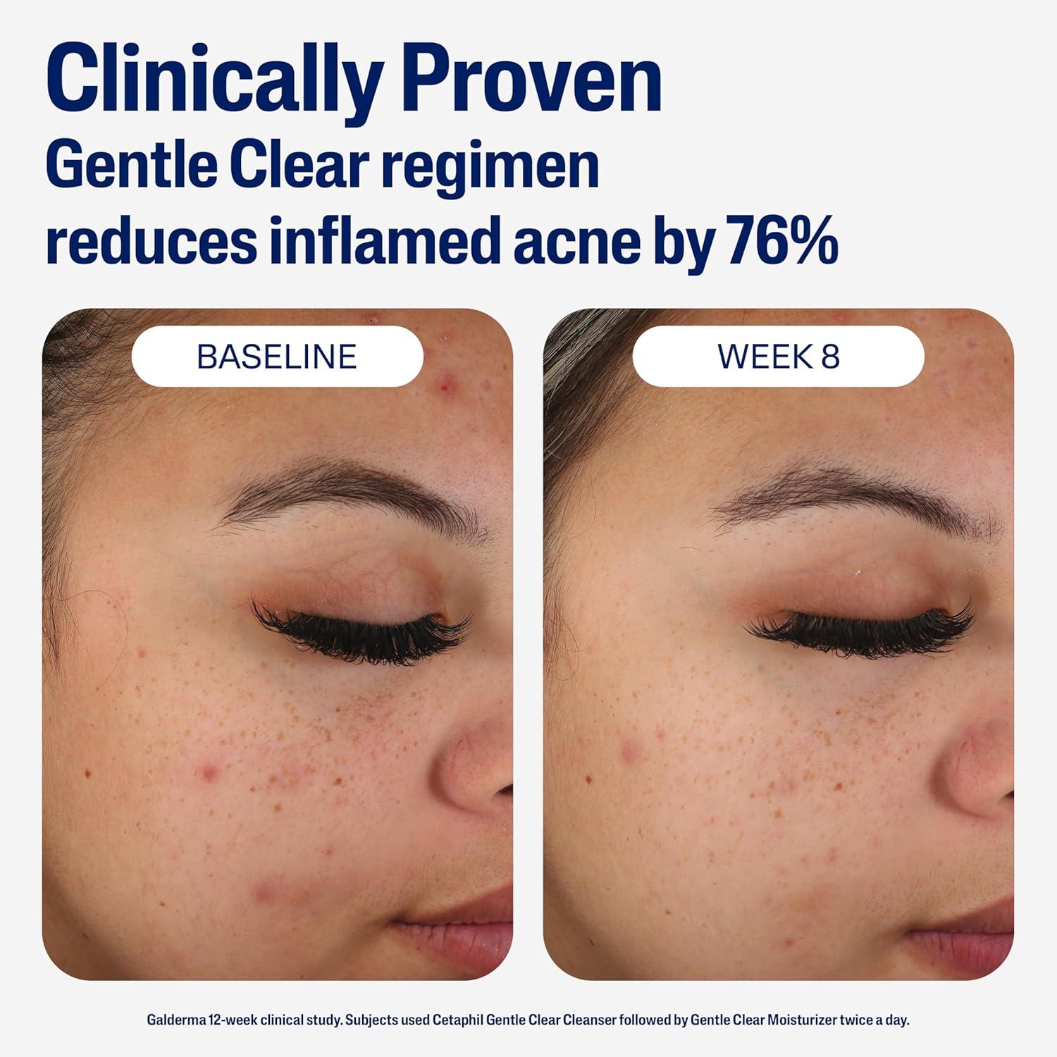 Cetaphil Gentle Clear Complexion-Clearing BPO Acne Cleanser with 2.6% Benzoyl Peroxide, Creamy and Soothing for Sensitive Skin, Suitable for All Skin Types, 4.2oz(Moisturizer)