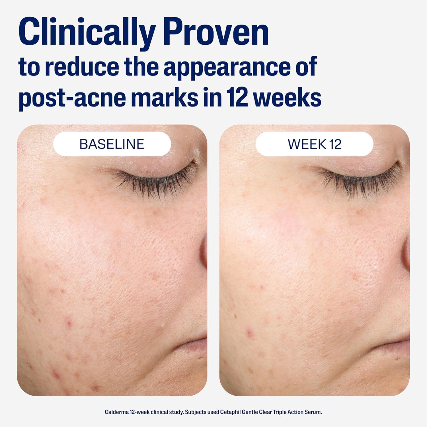 CETAPHIL Gentle Clear Repairing Post-Acne Serum, Retinol Alternative, Oil Free Serum for Sensitive Skin, 1 Fl Oz, Bakuchiol, Improves Skin Tone & Post-acne Marks, Dermatologist Recommended Brand