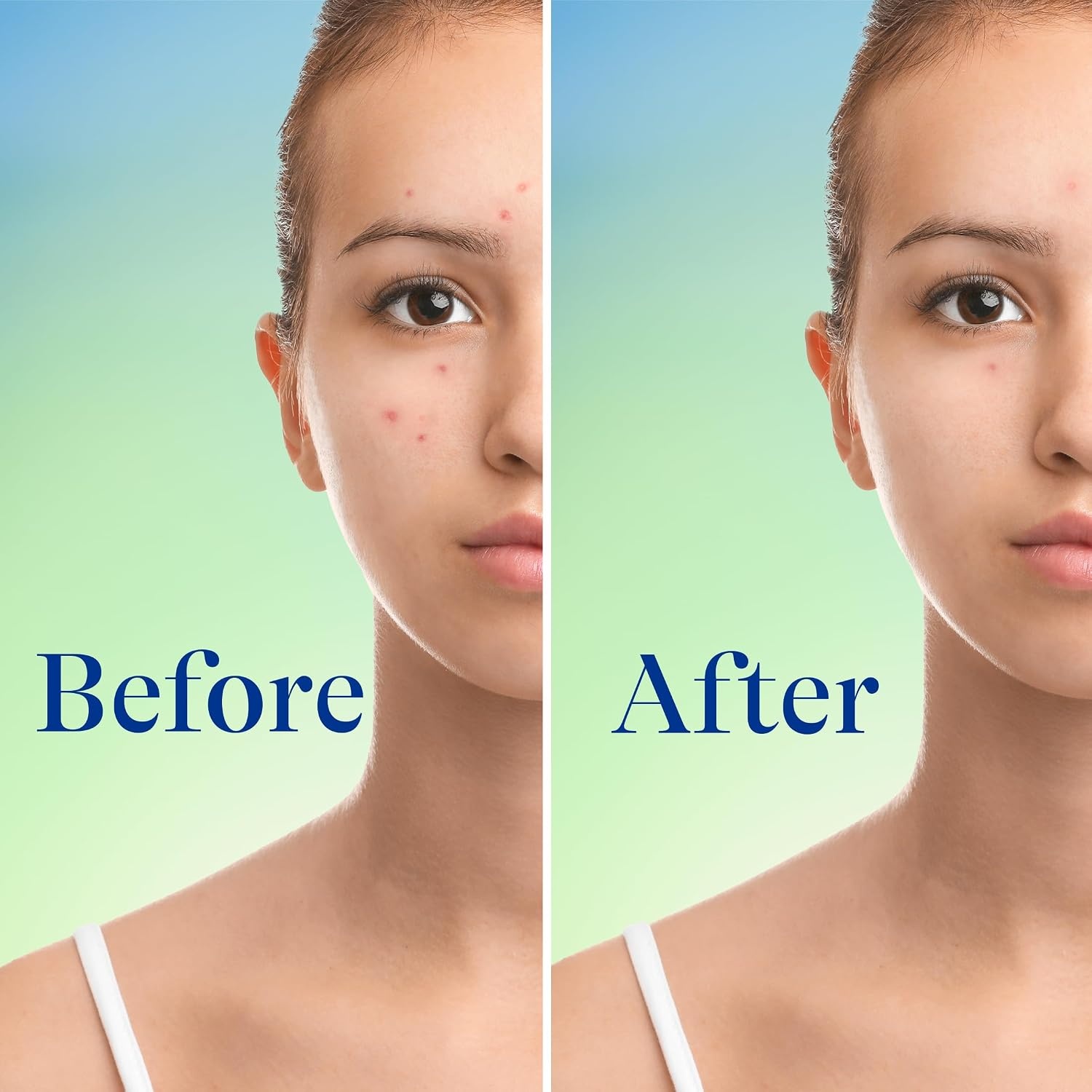 Differin Acne Face Wash with 10% Benzoyl Peroxide, Maximum Strength OTC Acne Foaming Cleanser, Fast Acting Acne Treatment for Face and Body, 5 oz.(NEW 5oz)