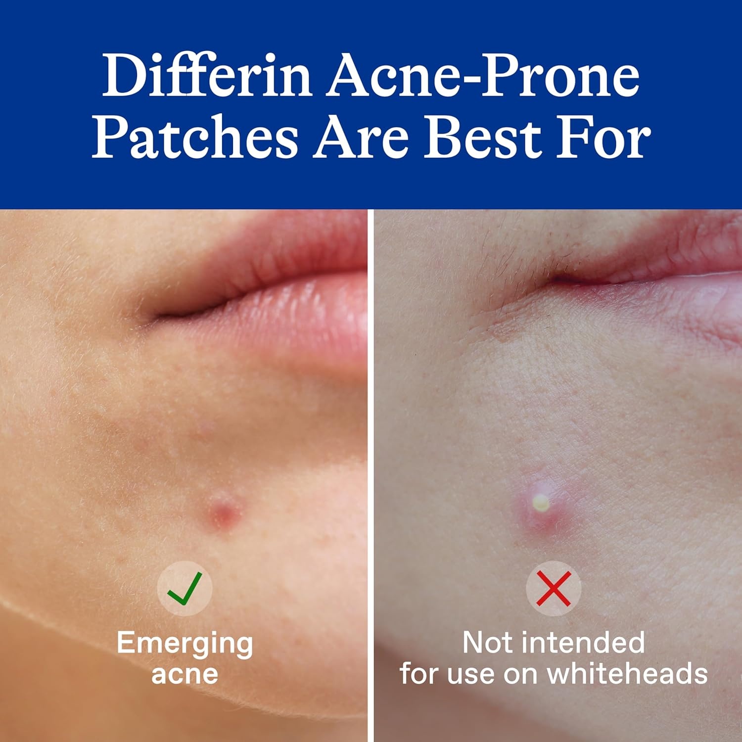 Differin Acne Patches, Pimple Patches for Acne Prone Skin, Formulated with Salicylic Acid and Centella, Fast Triple Action Power Patch for Day & Night, Dermatologist Tested, 36 Count(36 Count (Pack of 1))