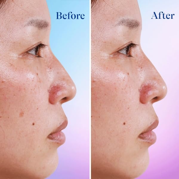 Differin Dark Spot Correcting Face Serum, Dark Spot Correcting Serum by the makers of Differin Gel, Gentle Skin Care for Acne Prone Sensitive Skin, 1 oz (Packaging May Vary)(Dark Spot Serum)