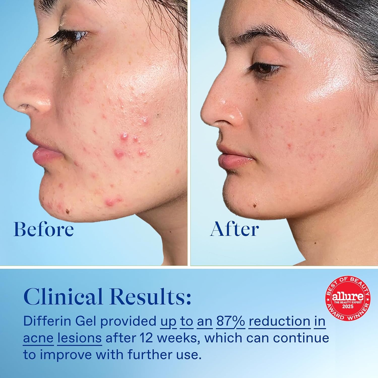 Differin Acne Treatment Gel, 30 Day Supply, Retinoid Treatment for Face with 0.1% Adapalene, Gentle Skin Care for Acne Prone Sensitive Skin, 15g Pump (Packaging May Vary)(15g (30 Day Supply))
